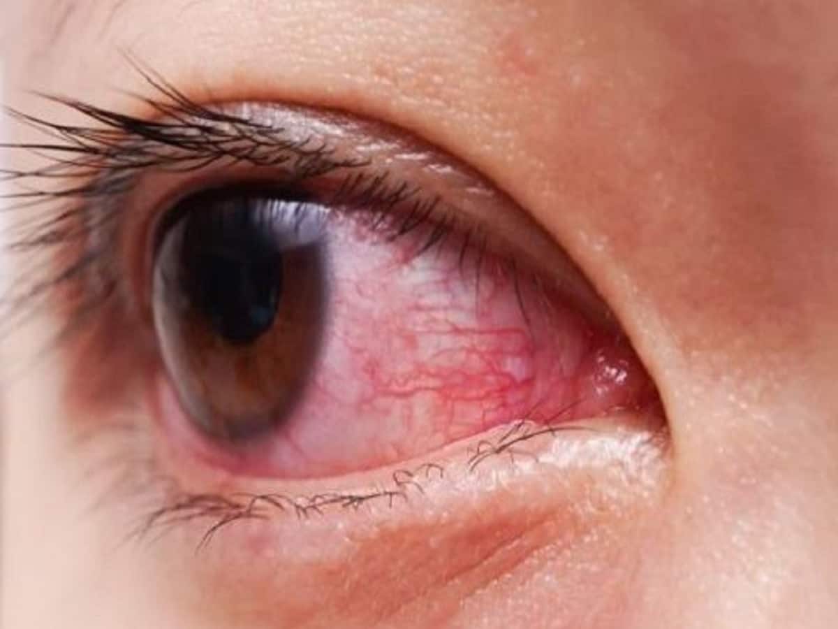 Common Eye Infections During The Monsoon And How To Prevent Them